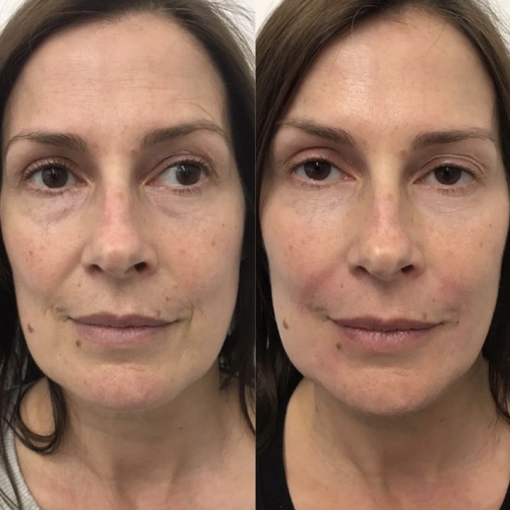 The CULTSKIN® Touch Lift