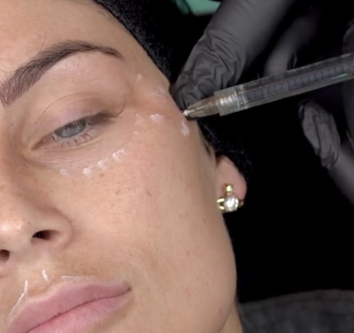 brow-lift