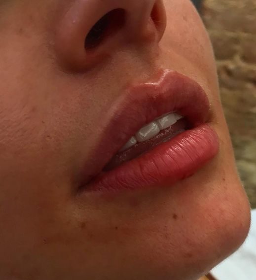 lip-augmentation