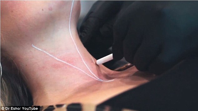 viscoderm