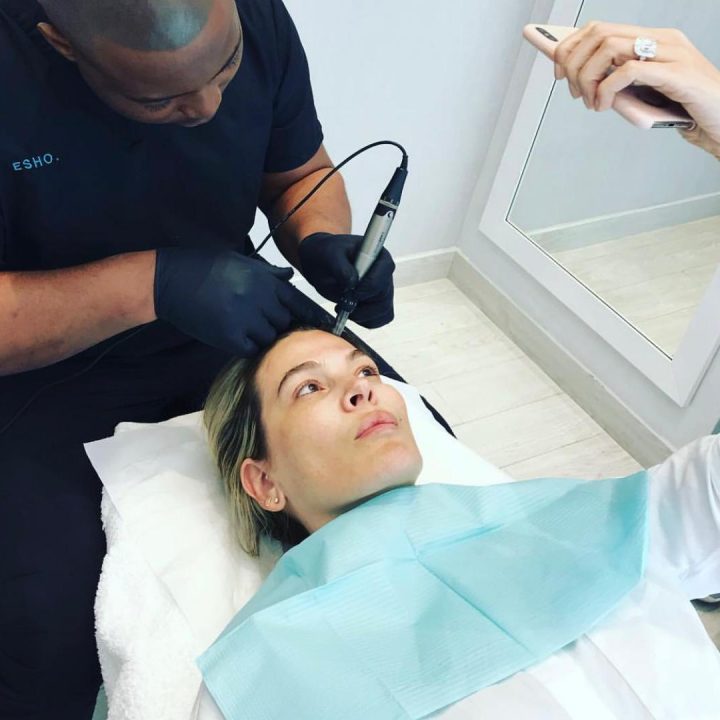 Advanced MicroNeedling