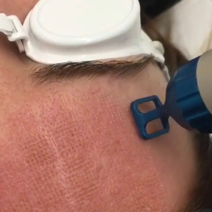 iPixel Laser by Alma Lasers
