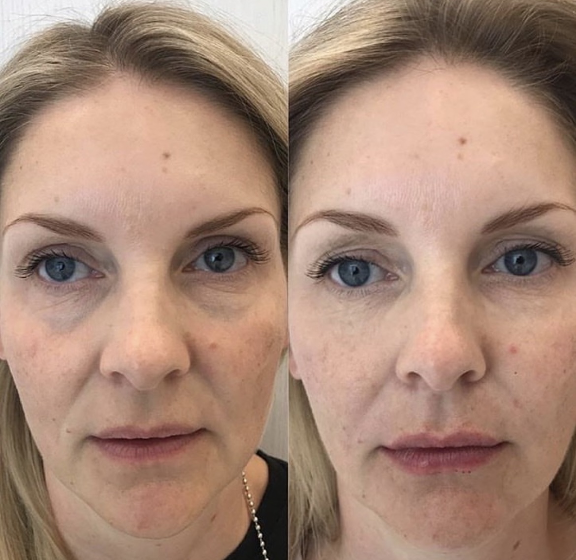 Nasolabial Folds Using Fillers | CULTSKIN®