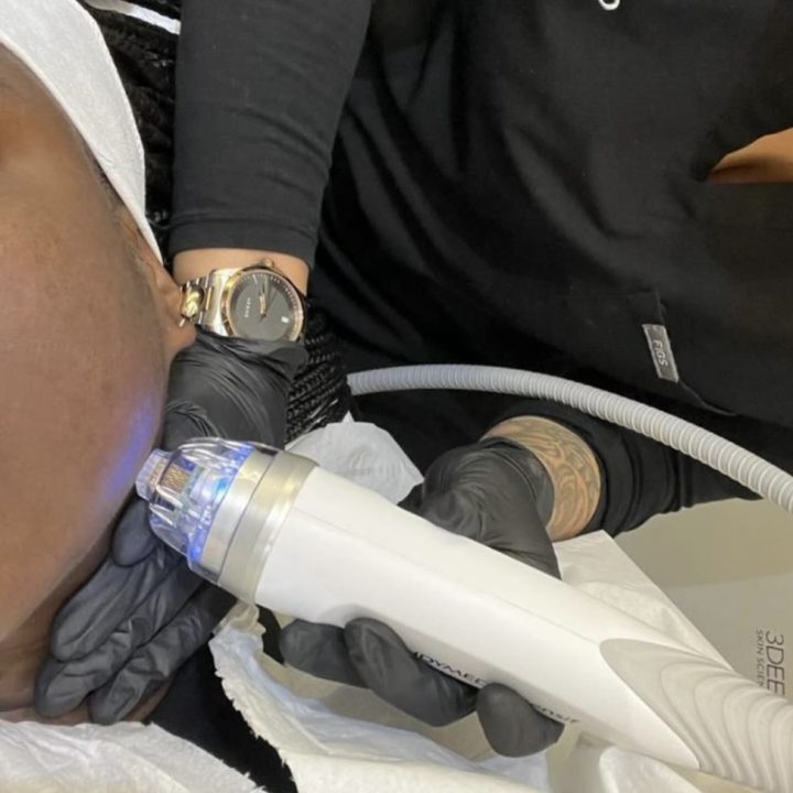 Combination RF Micro-Needling