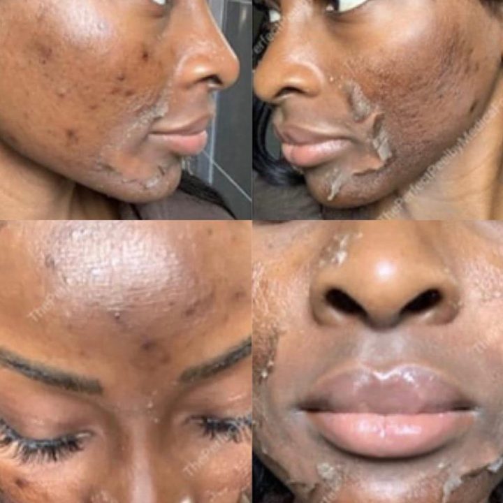 VI Peel
