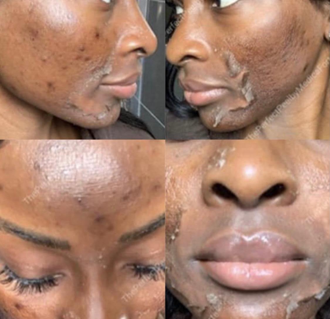 VI Peel at CULTSKIN